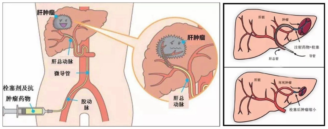 介入示意图.jpg