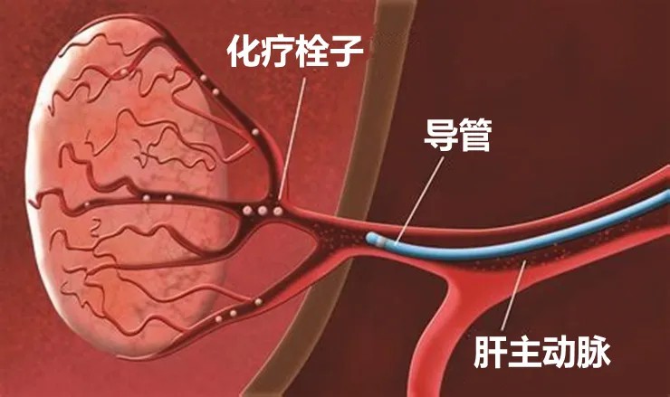 介入.jpg